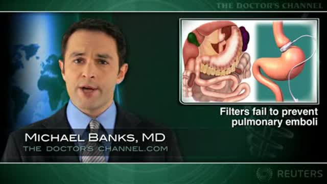 Value of vena cava filter after bariatric surgery questioned Thumbnail