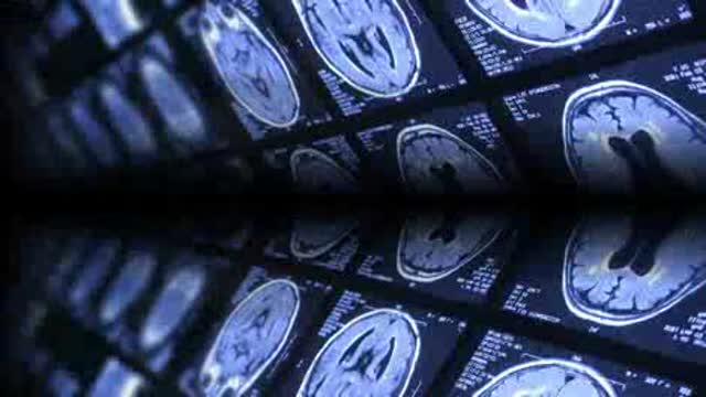 Epilepsy: Selection of Initial Drug Therapy Thumbnail