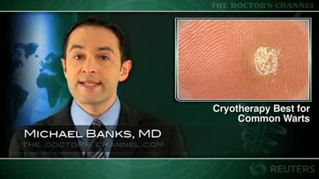 Cryotherapy works best for common warts Thumbnail