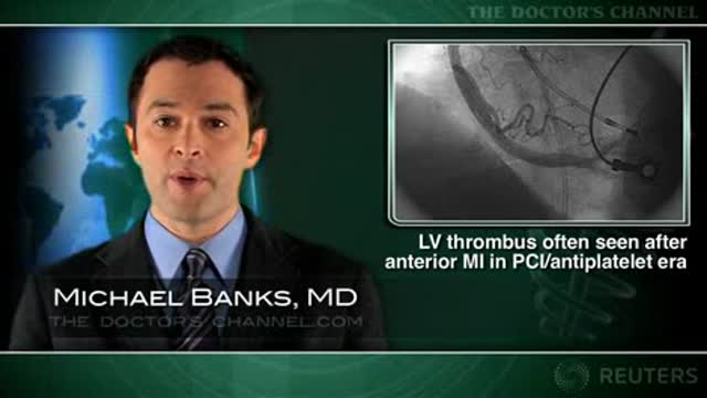 LV thrombus often seen after PCI in patients with anterior MI on antiplatelet therapy Thumbnail