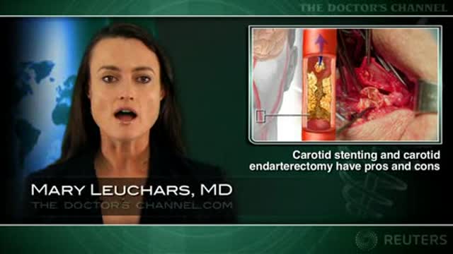 Pros and cons of carotid stenting versus carotid endarterectomy delineated Thumbnail