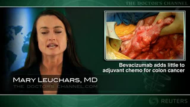 Bevacizumab adds little to adjuvant chemo for colon cancer Thumbnail