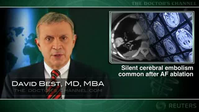 High rate of silent cerebral embolism seen with catheter ablation of atrial fibrillation Thumbnail