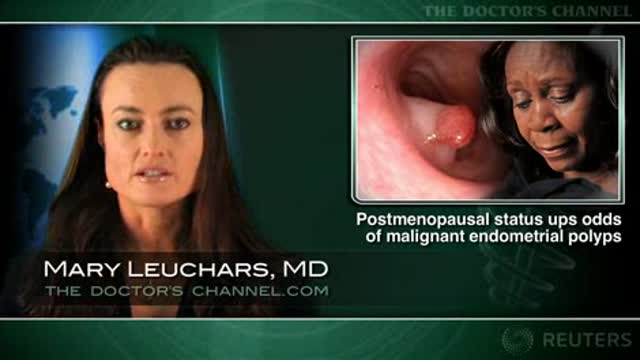 Postmenopausal status, bleeding are risk factors for malignant endometrial polyps Thumbnail