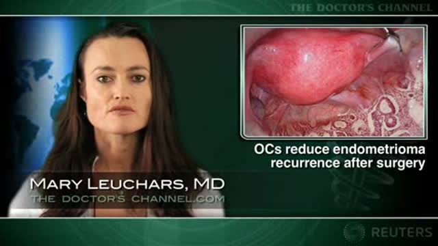 Oral contraceptives reduce endometrioma recurrence after surgery Thumbnail