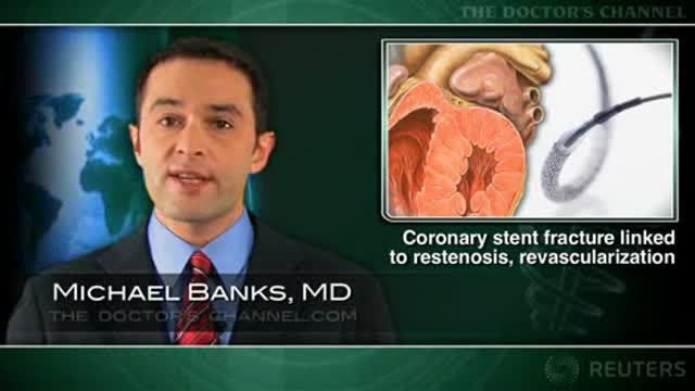 Coronary stent fracture linked to restenosis, revascularization Thumbnail