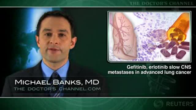 Gefitinib, erlotinib may slow CNS metastases in advanced lung cancer Thumbnail