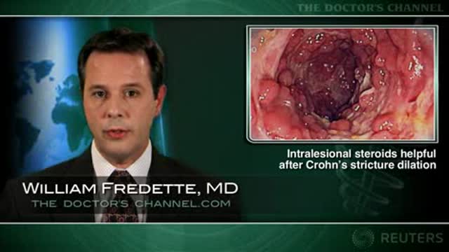 Intralesional steroids beneficial after Crohn’s stricture dilation in children Thumbnail