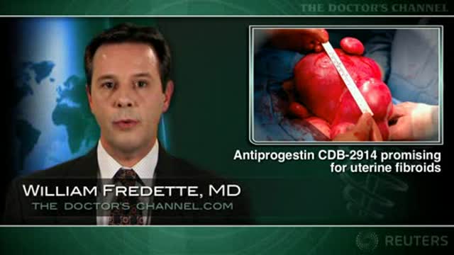 Investigational drug promising for uterine fibroids Thumbnail