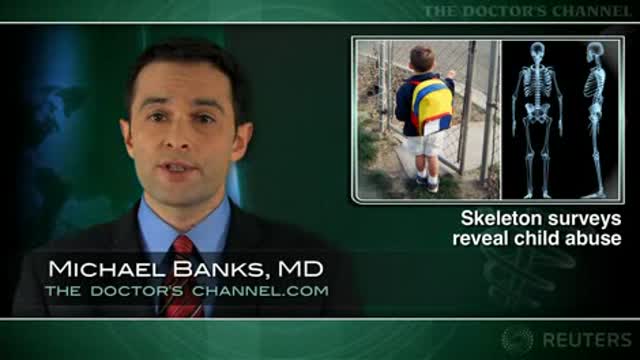 Skeletal survey fosters detection of child physical abuse Thumbnail