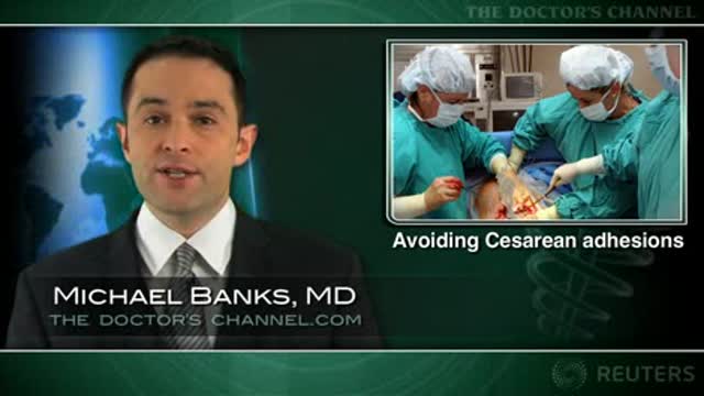 Peritoneal closure reduces adhesion formation after cesarean section Thumbnail