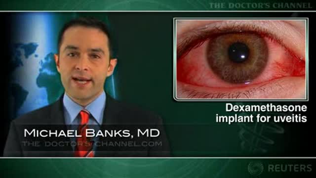 Dexamethasone implant may clear uveitis Thumbnail
