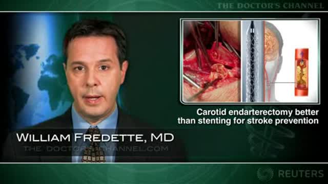 Carotid endarterectomy seen superior to stenting for stroke prevention Thumbnail