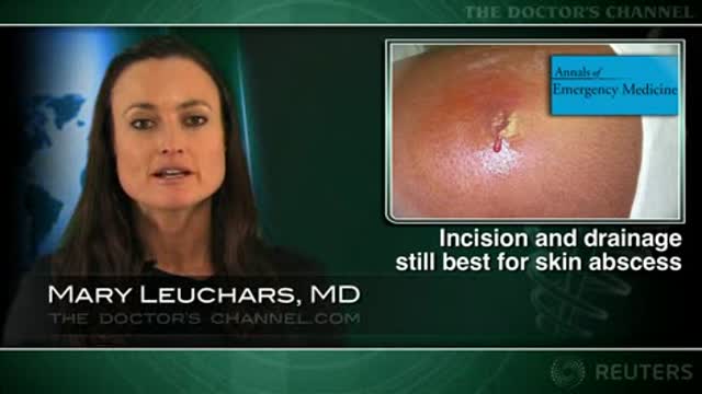 Ultrasound-guided needle aspiration “insufficient” for skin abscesses Thumbnail