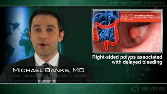 Risk of delayed bleeding higher with right-sided polyp removal Thumbnail