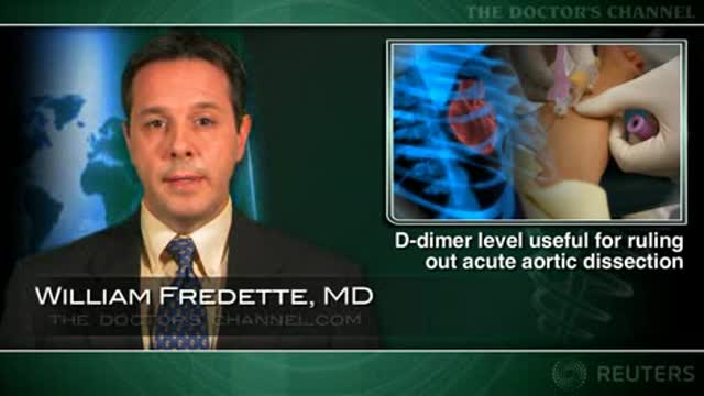 D-dimer measurement useful for ruling out acute aortic dissection Thumbnail
