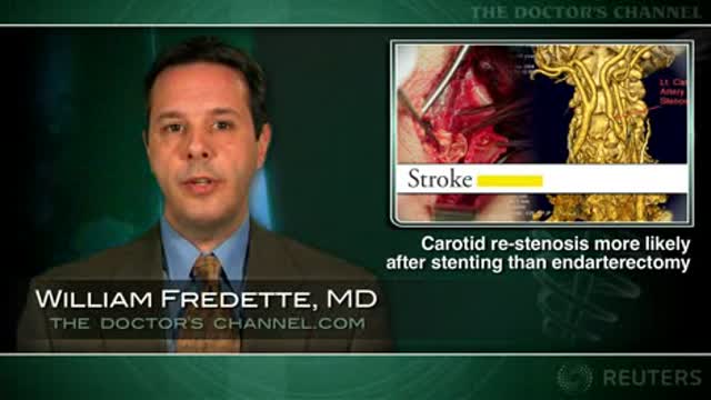 Restenosis seen more often after carotid stenting than endarterectomy Thumbnail