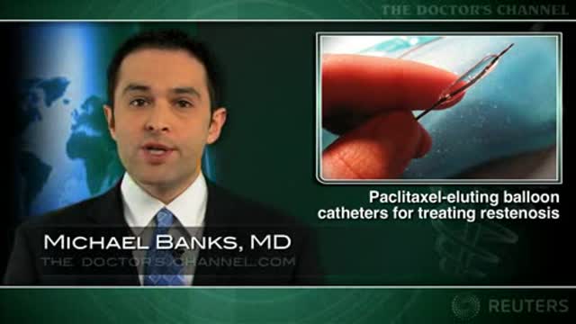 Paclitaxel-eluting balloon catheter promising for sirolimus-eluting stent restenosis Thumbnail