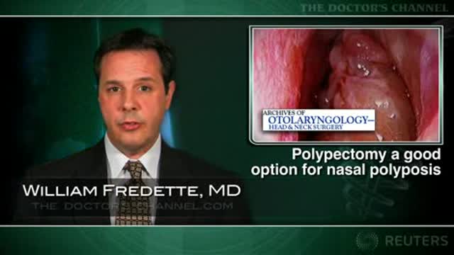 Polypectomy a good option for nasal polyposis Thumbnail