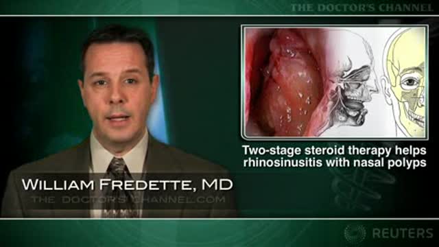 Initial oral steroids seen helpful in chronic rhinosinusitis with nasal polyps Thumbnail