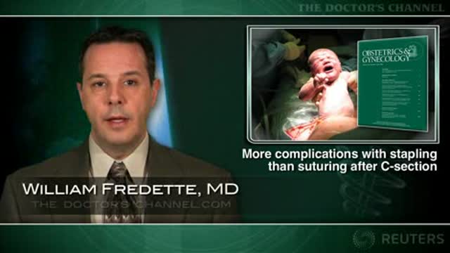Staple closure after c-section associated with more wound complications Thumbnail