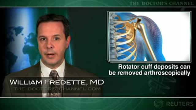 Calcium deposits in rotator cuff can be removed arthroscopically Thumbnail