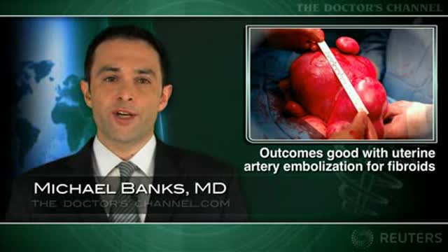 Outcomes similar after uterine artery embolization or surgery for fibroids Thumbnail