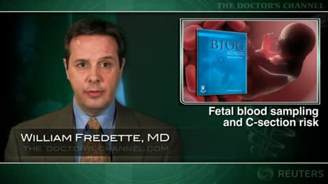Fetal blood sampling in early labor may raise risk of cesarean delivery Thumbnail