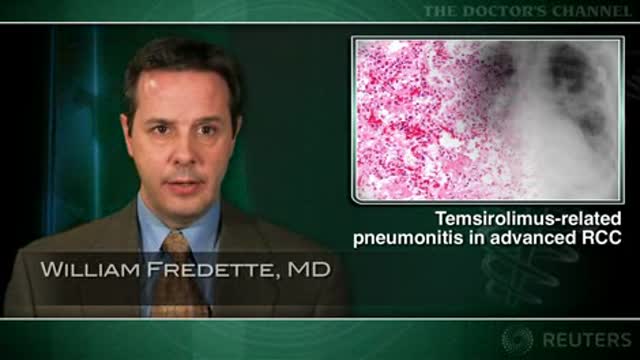 Temsirolimus-related pneumonitis common in advanced renal cell carcinoma Thumbnail