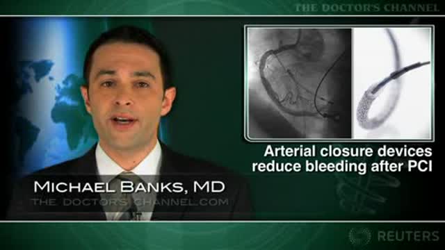 Arterial closure devices reduce bleeding after PCI Thumbnail