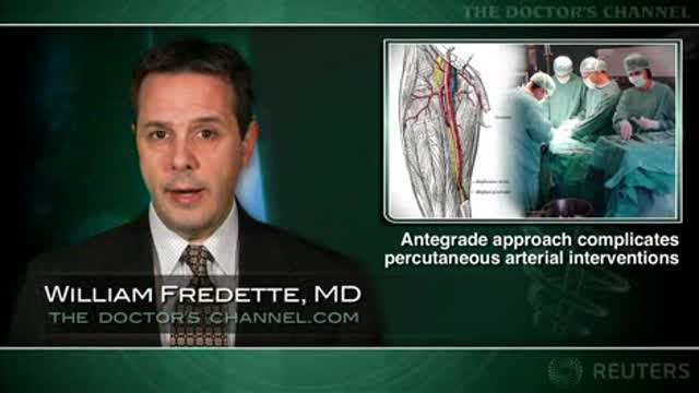 Caution advised with antegrade access for percutaneous arterial interventions Thumbnail