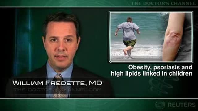 Psoriasis, obesity and high lipids tied in children Thumbnail