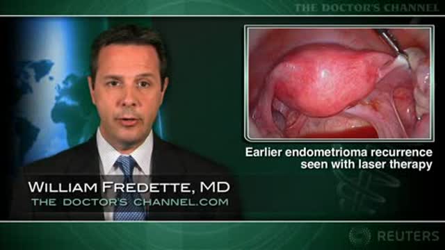 Earlier endometrioma recurrence seen with laser therapy Thumbnail