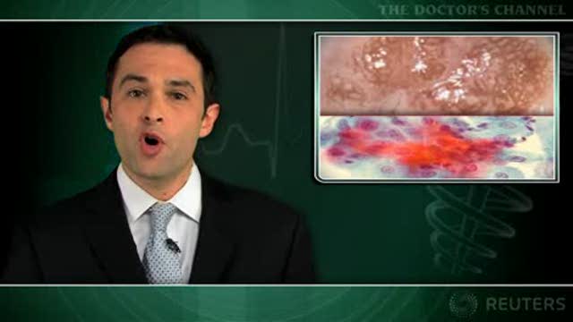 CIN risk low in HPV+ women with normal colposcopy results Thumbnail