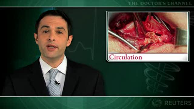 MI more frequent after carotid endarterectomy than stenting Thumbnail