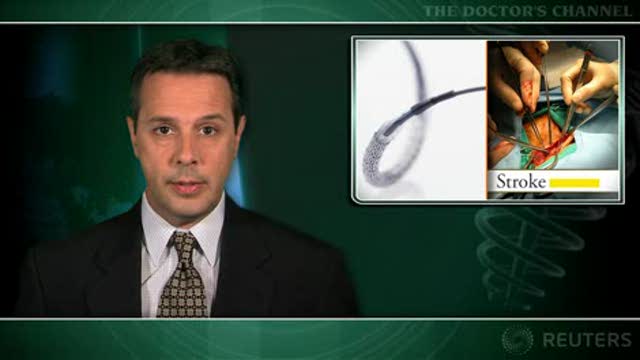 Carotid artery stenting or endarterectomy for stroke prevention in elderly? Thumbnail