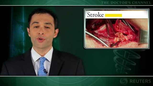 Inhibitor of von Willebrand factor reduces thromboembolism after carotid endarterectomy Thumbnail