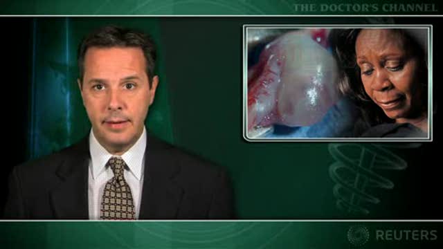 Ovarian cysts not a cancer risk factor Thumbnail