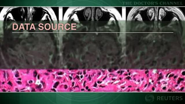 Surgery should be first treatment for intracranial hemangiopericytoma Thumbnail