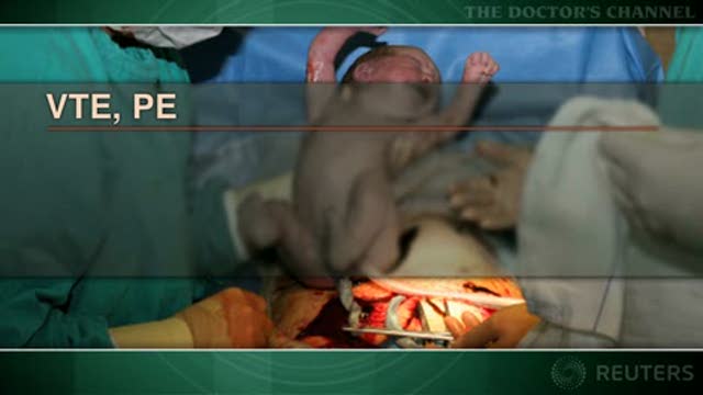 New ACOG guidelines for clot prevention during pregnancy Thumbnail