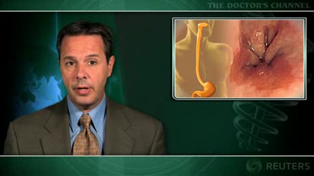 Barrett’s esophagus ablation can bury metaplastic glands Thumbnail