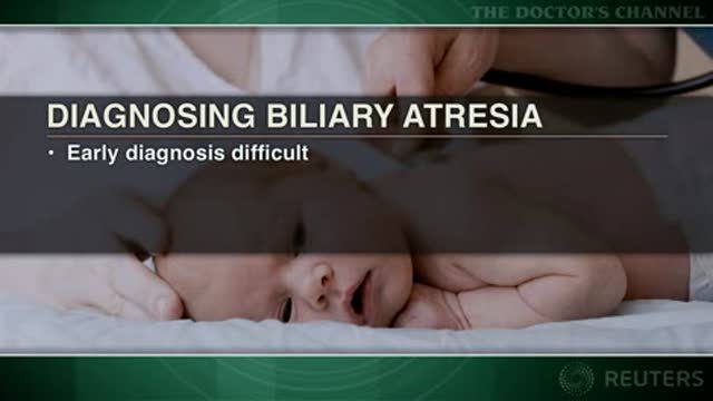High bilirubin at birth may indicate risk of biliary atresia Thumbnail