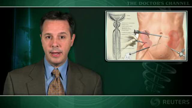 Ureteroscopy ‘best’ option for most patients with large proximal ureteral stones Thumbnail