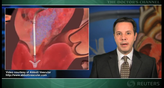 Percutaneous mitral leaflet repair effective for high-risk surgical patients Thumbnail