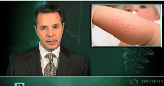 Coronary artery lesions develop if Kawasaki disease treatment is delayed Thumbnail