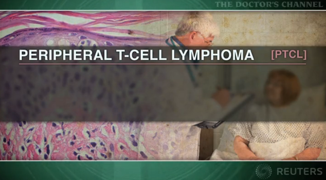 Romidepsin effective for refractory peripheral T-cell lymphoma Thumbnail