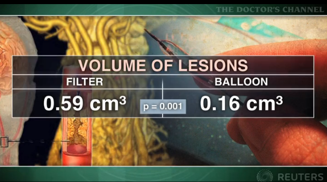 Proximal balloon occlusion better than filter protection in carotid artery stenting Thumbnail
