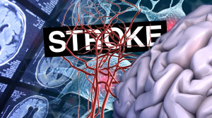 Dual antiplatelet therapy reduces stroke recurrence risk Thumbnail