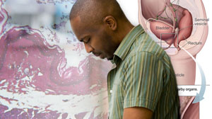 Androgen deprivation for prostate cancer ups peripheral vascular risk Thumbnail