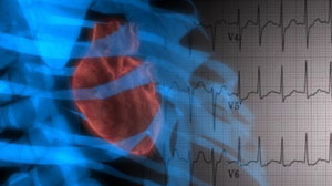 AF ablation improves outcomes in concomitant heart failure treated with CRT Thumbnail